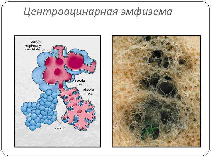 Центроацинарная эмфизема 