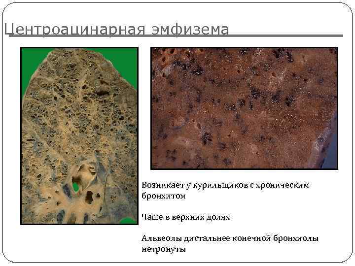 Центроацинарная эмфизема Возникает у курильщиков с хроническим бронхитом Чаще в верхних долях Альвеолы дистальнее