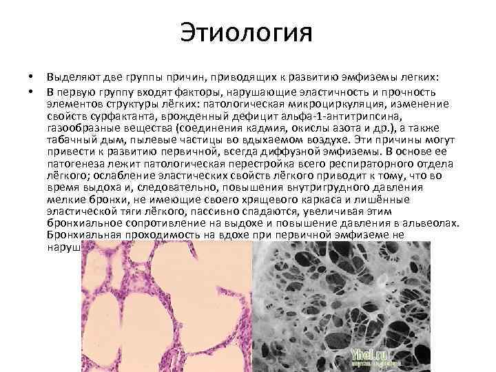 Синдром повышенной. Эмфизема легких этиология. Эмфизема лёгких этиология. Синдром повышенной воздушности легочной ткани патогенез. При эмфиземе легких наблюдается увеличение:.