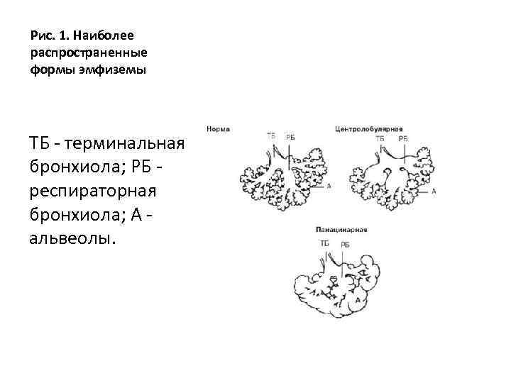 Рис. 1. Наиболее распространенные формы эмфиземы ТБ - терминальная бронхиола; РБ респираторная бронхиола; А