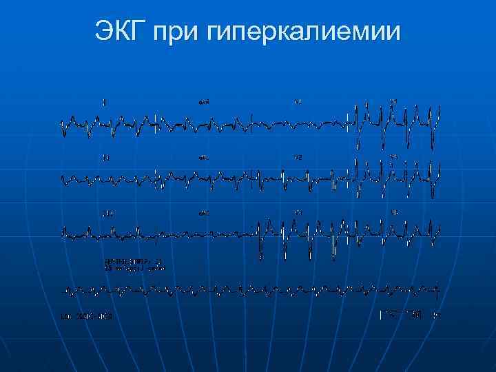 ЭКГ при гиперкалиемии 