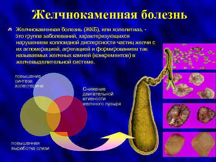 Желчнокаменная болезнь (ЖКБ), или холелитиаз, это группа заболеваний, характеризующихся нарушением коллоидной дисперсности частиц желчи