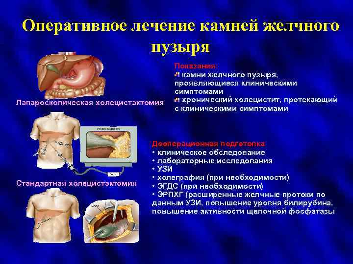 Оперативное лечение камней желчного пузыря Лапароскопическая холецистэктомия Стандартная холецистэктомия Показания: камни желчного пузыря, проявляющиеся