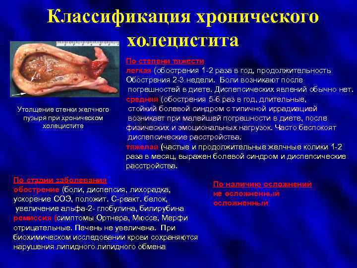 Классификация хронического холецистита Утолщение стенки желчного пузыря при хроническом холецистите По степени тяжести легкая