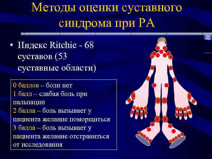Методы оценки суставного синдрома при РА • Индекс Ritchie - 68 суставов (53 суставные