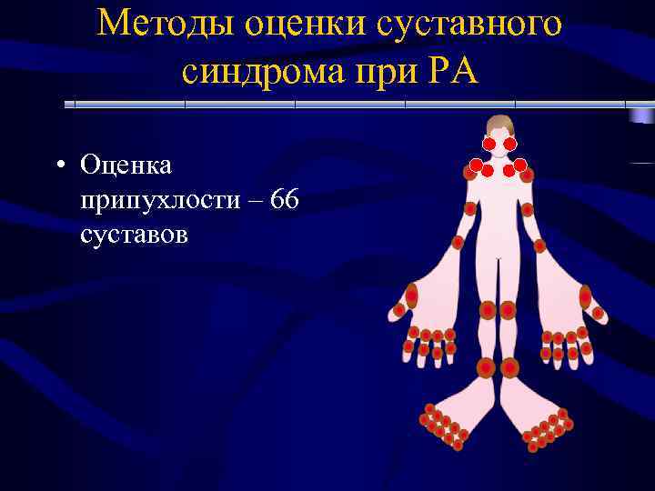 Методы оценки суставного синдрома при РА • Оценка припухлости – 66 суставов 
