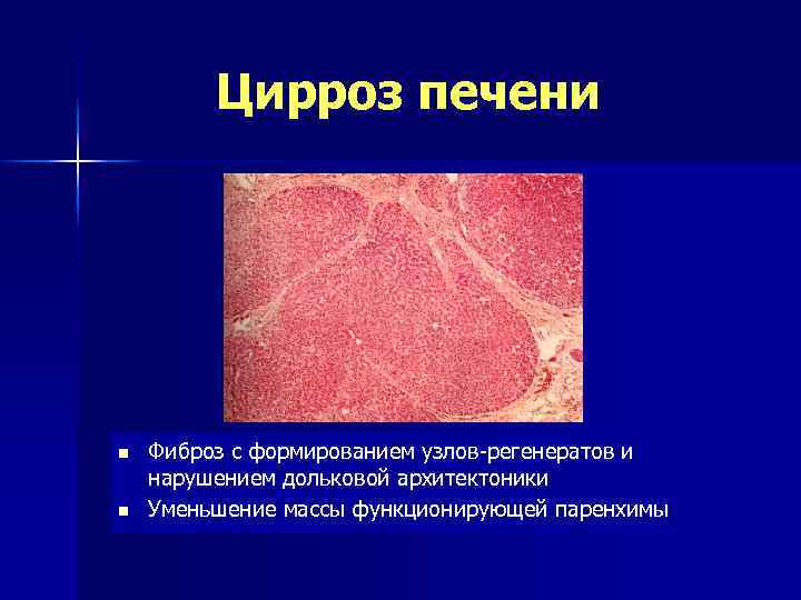 Цирроз печени n n Фиброз с формированием узлов-регенератов и нарушением дольковой архитектоники Уменьшение массы