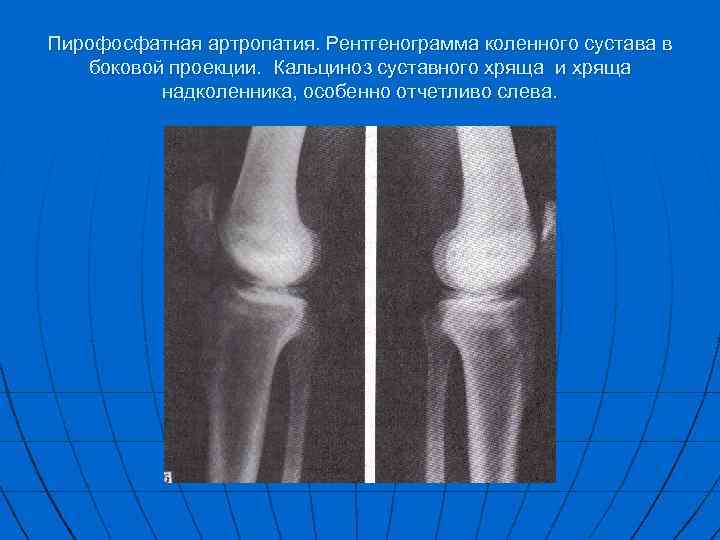 Рентген коленного сустава в двух проекциях фото в норме