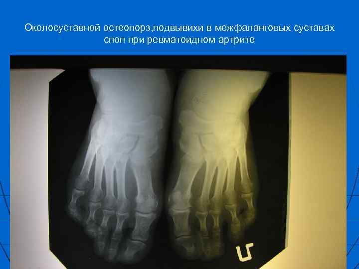 Околосуставной остеопорз, подвывихи в межфаланговых суставах споп при ревматоидном артрите 
