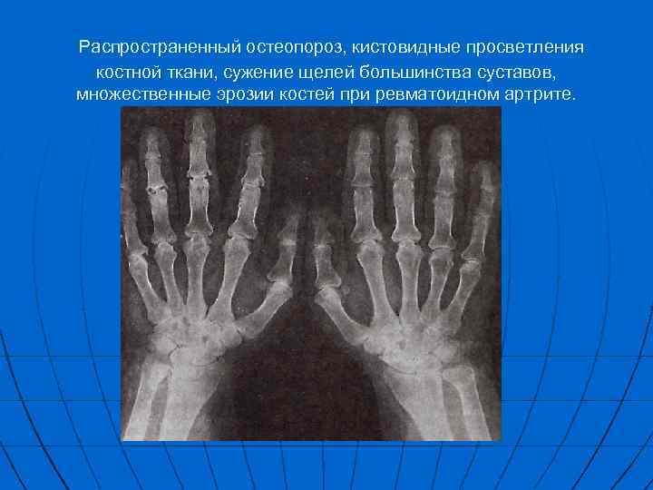 Распространенный остеопороз, кистовидные просветления костной ткани, сужение щелей большинства суставов, множественные эрозии костей при