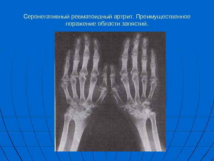 Ревматоидный артрит форум. Ревматоидный серативный артрит. Серонегативный ревматоидный артрит. Серонегативная форма ревматоидного артрита. Серонегативный ревматоидный артрит клиника.