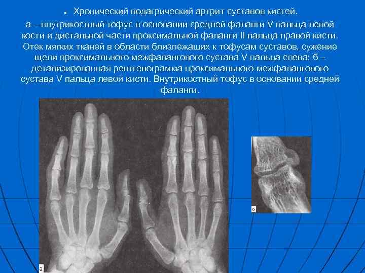 Контрактура сустава мкб. Ревматоидный артрит кисти рентген. Подагра суставов кисти на рентгене. Контрактура кисти рентген. Подагра ревматоидный артрит кистей.