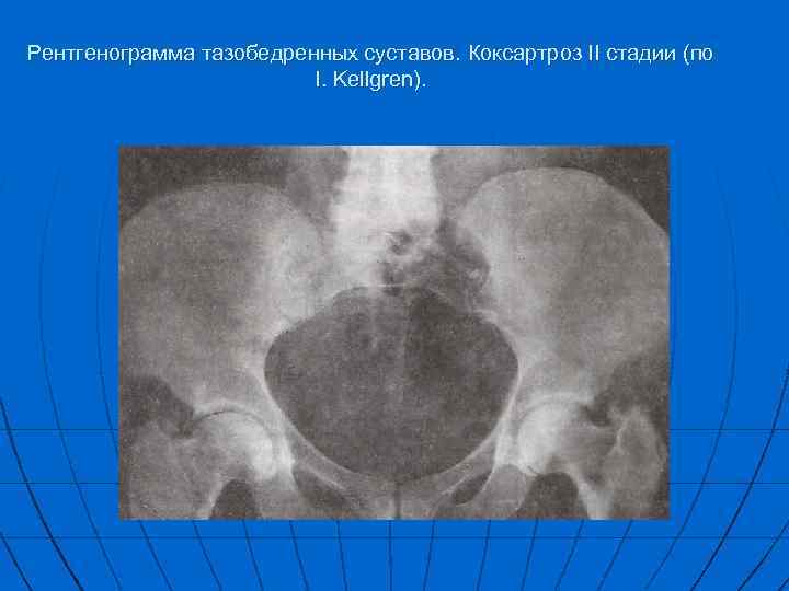 Рентгенограмма тазобедренных суставов. Коксартроз II стадии (по I. Kellgren). 