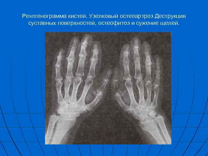 Рентгенограмма кистей. Узелковый остеоартроз Деструкция суставных поверхностей, остеофитоз и сужение щелей. 