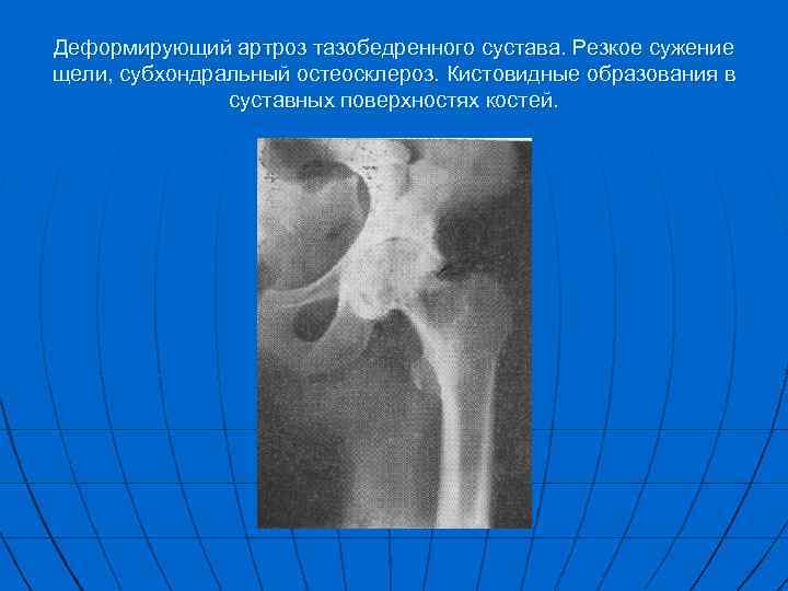 Деформирующий артроз тазобедренного сустава. Резкое сужение щели, субхондральный остеосклероз. Кистовидные образования в суставных поверхностях