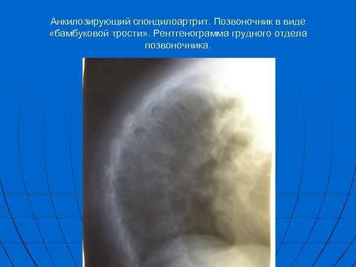 Анкилозирующий спондилоартрит. Позвоночник в виде «бамбуковой трости» . Рентгенограмма грудного отдела позвоночника. 