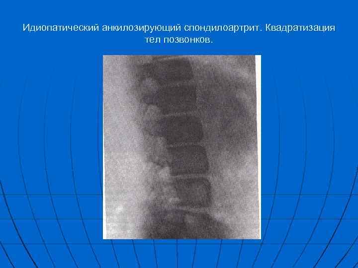 Болезнь бехтерева презентация госпитальная терапия