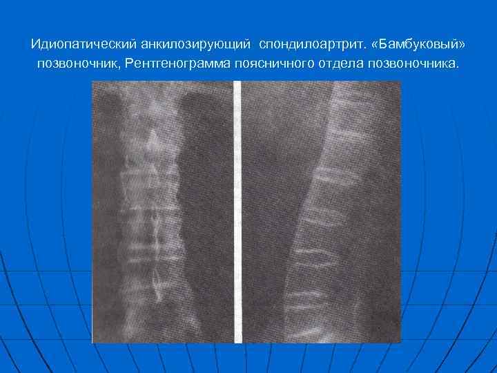 Идиопатический анкилозирующий спондилоартрит. «Бамбуковый» позвоночник, Рентгенограмма поясничного отдела позвоночника. 