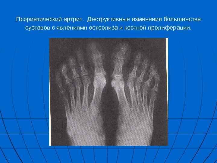 Псориатический артрит. Деструктивные изменения большинства суставов с явлениями остеолиза и костной пролиферации. 