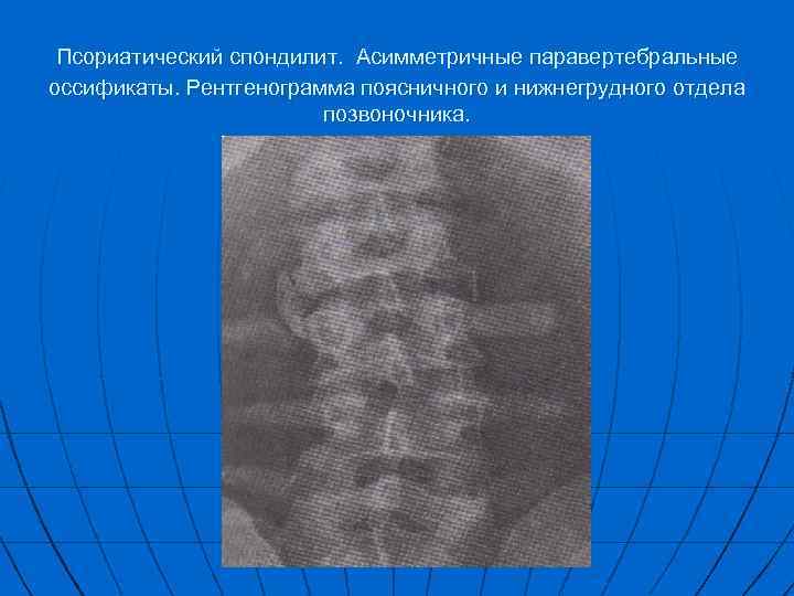 Псориатический спондилит. Асимметричные паравертебральные оссификаты. Рентгенограмма поясничного и нижнегрудного отдела позвоночника. 