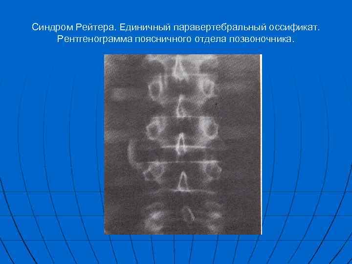 Синдром Рейтера. Единичный паравертебральный оссификат. Рентгенограмма поясничного отдела позвоночника. 