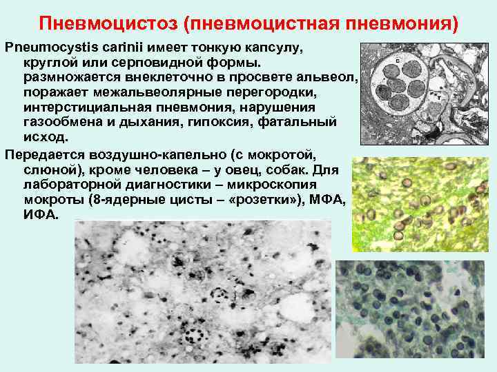 Пневмоцистоз