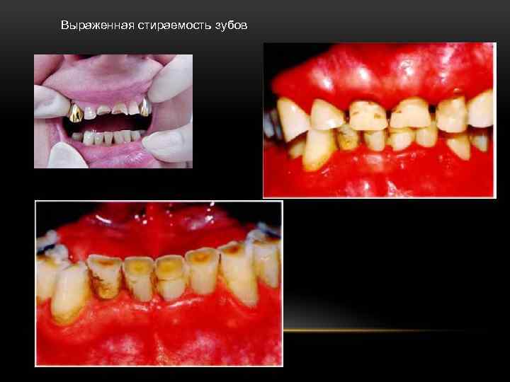 Выраженная стираемость зубов 