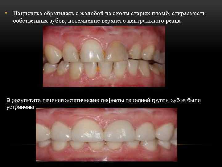  • Пациентка обратилась с жалобой на сколы старых пломб, стираемость собственных зубов, потемнение