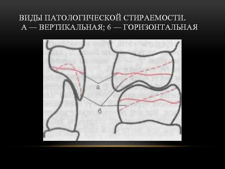 ВИДЫ ПАТОЛОГИЧЕСКОЙ СТИРАЕМОСТИ. А — ВЕРТИКАЛЬНАЯ; 6 — ГОРИЗОНТАЛЬНАЯ 