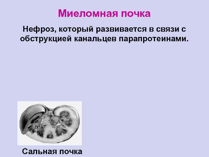 Миеломная почка Нефроз, который развивается в связи с обструкцией канальцев парапротеинами. Сальная почка 