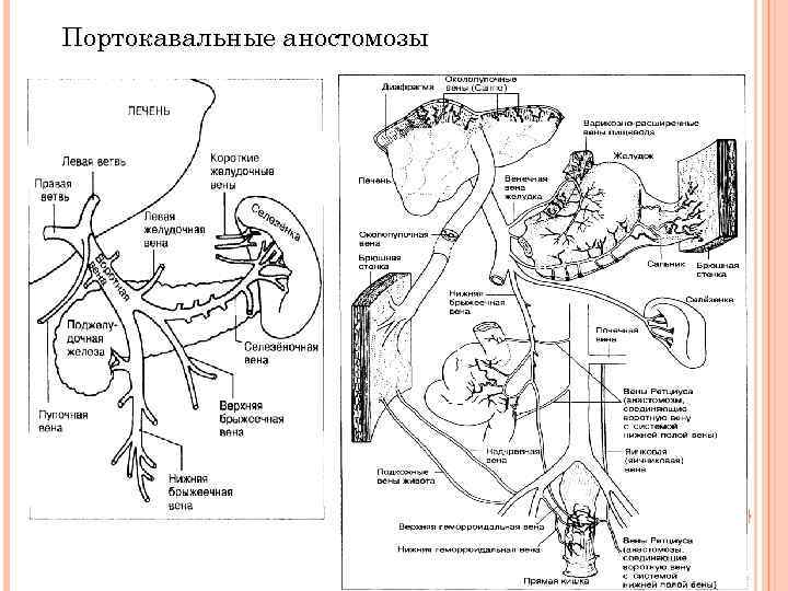 Портокавальные аностомозы 