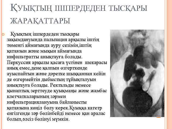 ҚУЫҚТЫҢ ІШПЕРДЕДЕН ТЫСҚАРЫ ЖАРАҚАТТАРЫ Қуықтың ішпердеден тысқары зақымдануында пальпация арқылы іштің төменгі аймағында ауру