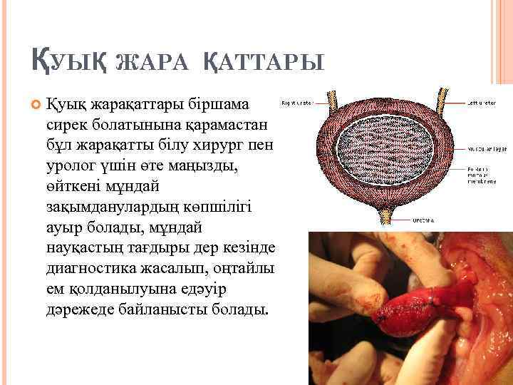 ҚУЫҚ ЖАРА ҚАТТАРЫ Қуық жарақаттары біршама сирек болатынына қарамастан бұл жарақатты білу хирург пен