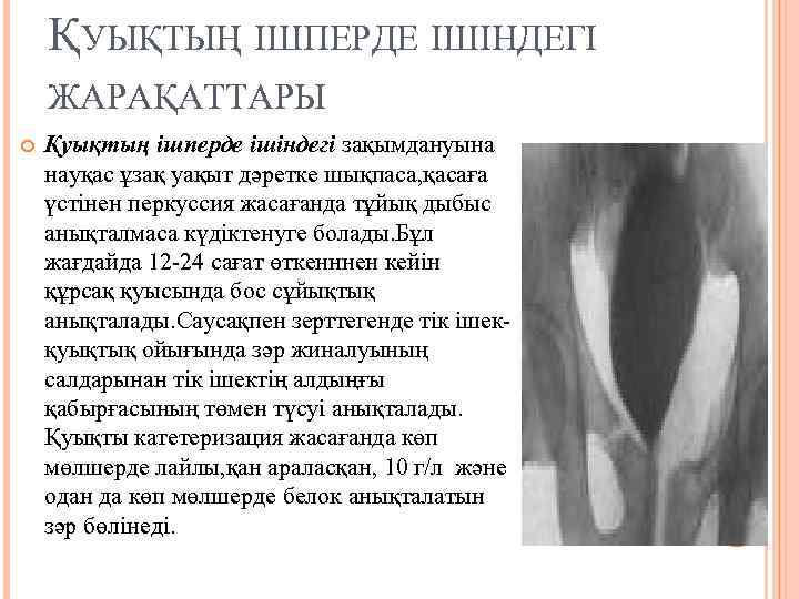 ҚУЫҚТЫҢ ІШПЕРДЕ ІШІНДЕГІ ЖАРАҚАТТАРЫ Қуықтың ішперде ішіндегі зақымдануына науқас ұзақ уақыт дәретке шықпаса, қасаға