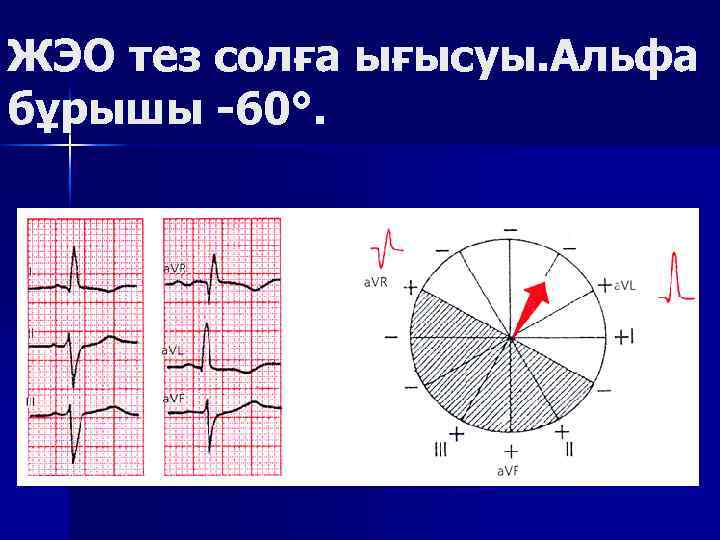 ЖЭО тез солға ығысуы. Альфа бұрышы -60°. 