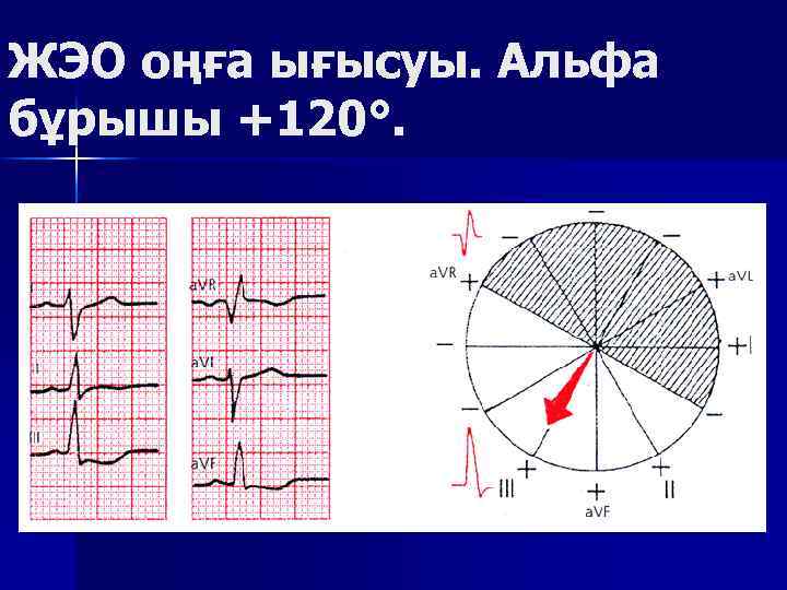 ЖЭО оңға ығысуы. Альфа бұрышы +120°. 