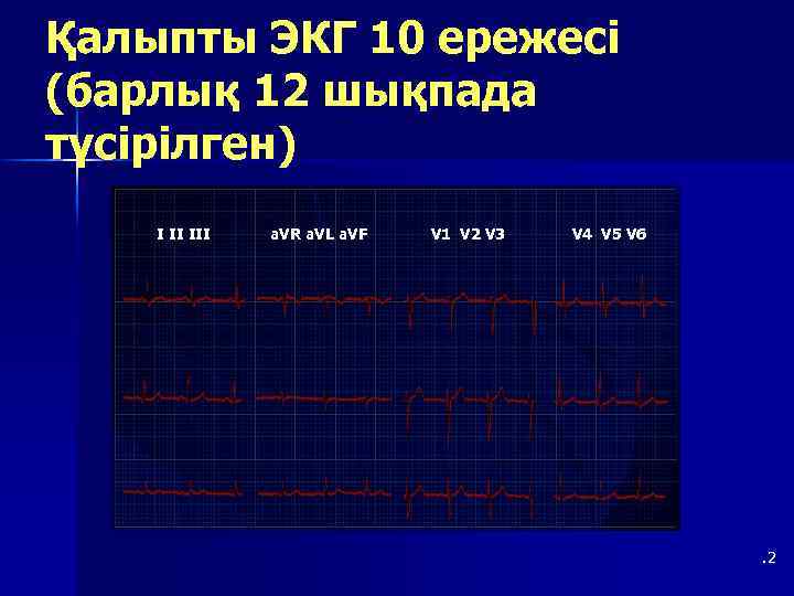 Қалыпты ЭКГ 10 ережесі (барлық 12 шықпада түсірілген) I II III a. VR a.