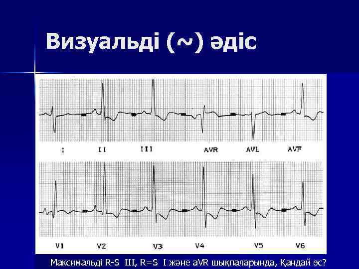 Визуальді (~) әдіс Максимальді R S III, R=S I және a. VR шықпаларында, Қандай