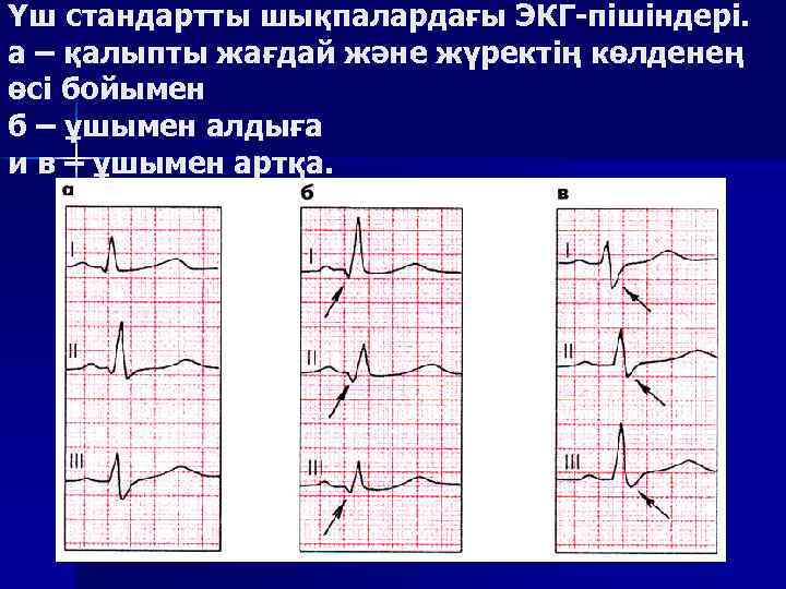 Үш стандартты шықпалардағы ЭКГ-пішіндері. а – қалыпты жағдай және жүректің көлденең өсі бойымен б