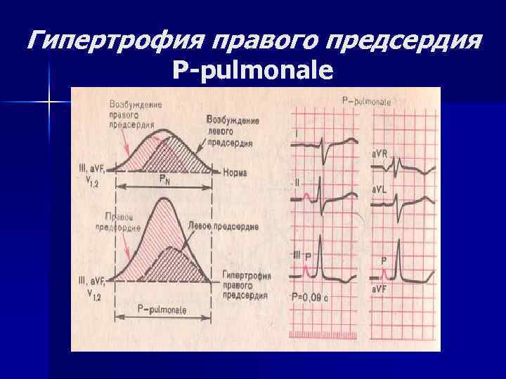 Гипертрофия правого предсердия P-pulmonale 