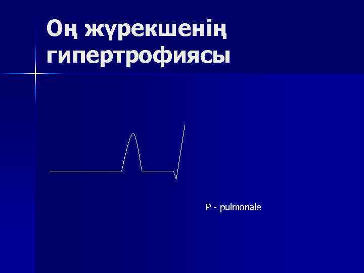 Оң жүрекшенің гипертрофиясы Р pulmonale 