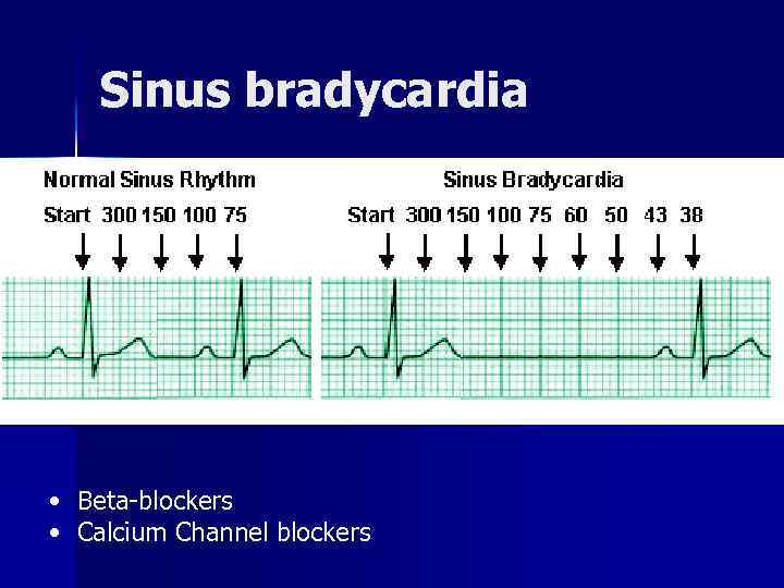Sinus bradycardia • Beta blockers • Calcium Channel blockers 