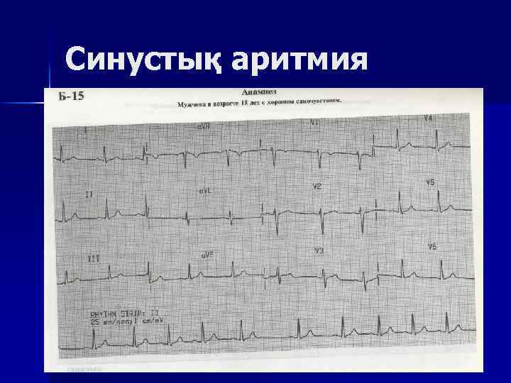 Синустық аритмия 