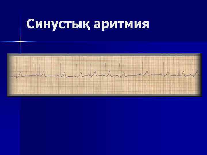 Синустық аритмия 