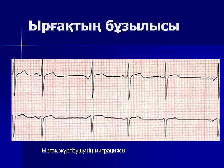 Ырғақтың бұзылысы Ырғақ жүргізушунің миграциясы 