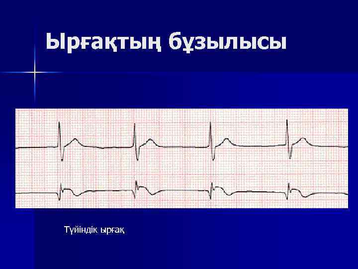 Ырғақтың бұзылысы Түйіндік ырғақ 
