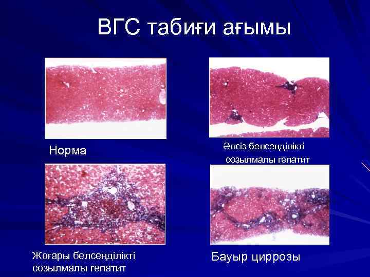 ВГС табиғи ағымы Норма Жоғары белсеңділікті созылмалы гепатит Әлсіз белсеңділікті созылмалы гепатит Бауыр циррозы