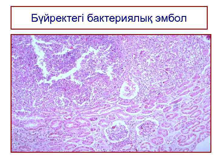 Бүйректегі бактериялық эмбол 