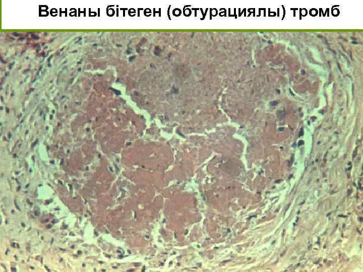 Венаны бітеген (обтурациялы) тромб 