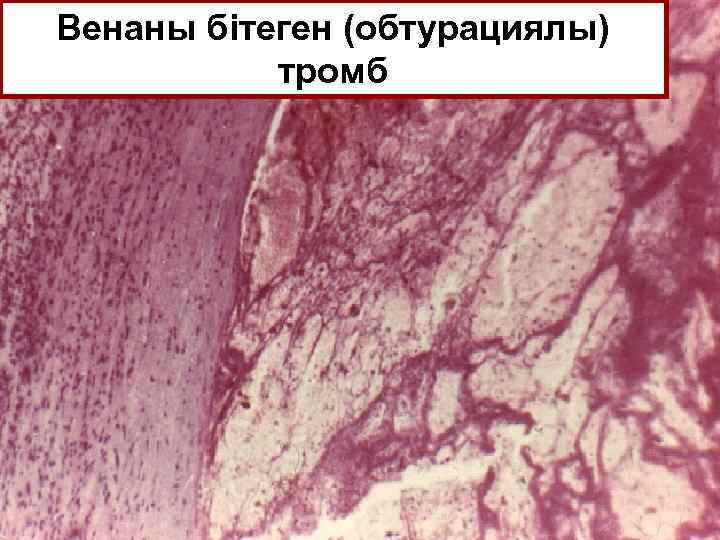 Венаны бітеген (обтурациялы) тромб 